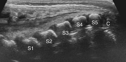 Neonatal Spinal Dimple | Radiology Key