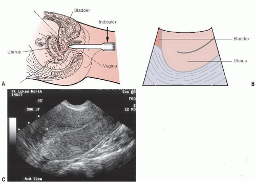 Pelvic Ultrasound in the Nongravid Patient | Radiology Key