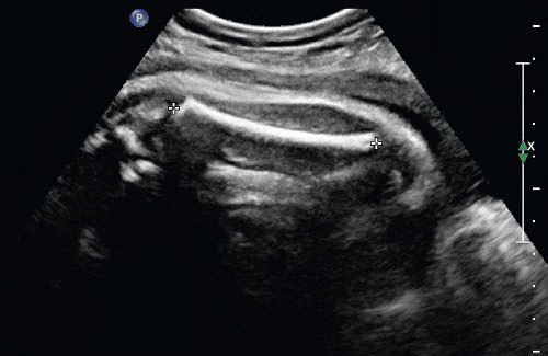 dating pregnancy ultrasound