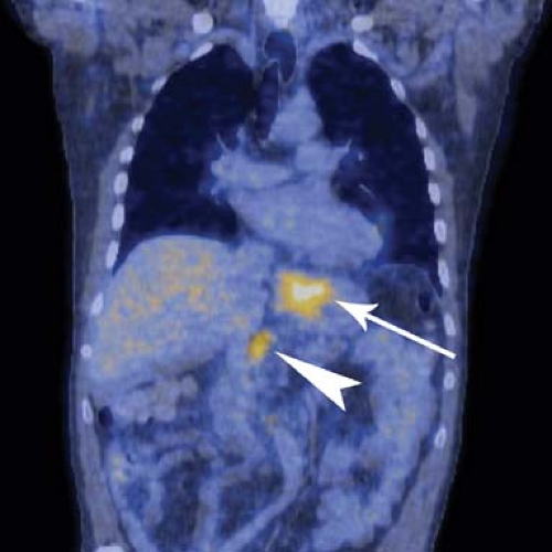 Gastrointestinal Liverspleen And Hepatobiliary Scintigraphy Radiology Key