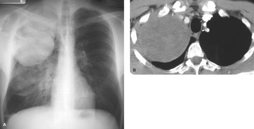 Pulmonary Neoplasms Radiology Key