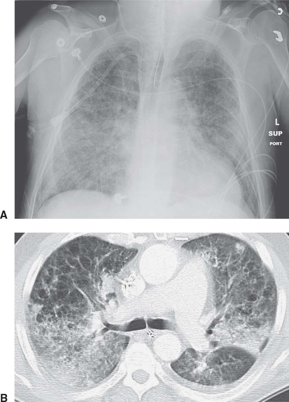 Interstitial Lung Disease | Radiology Key