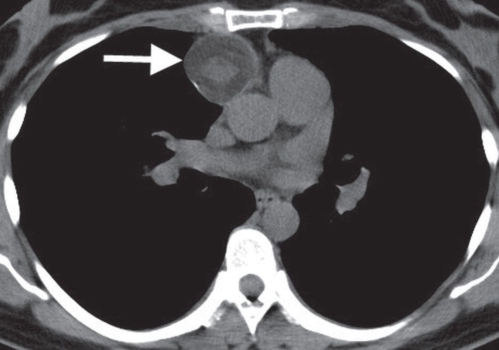 mediastinal-masses-radiology-key