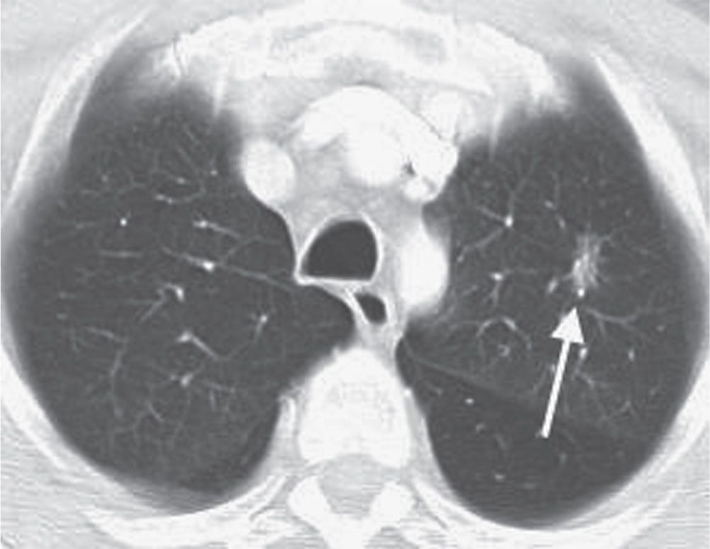 Ct Thorax Of Left Upper Lung Nodule As Identified By Arrow A Before Images
