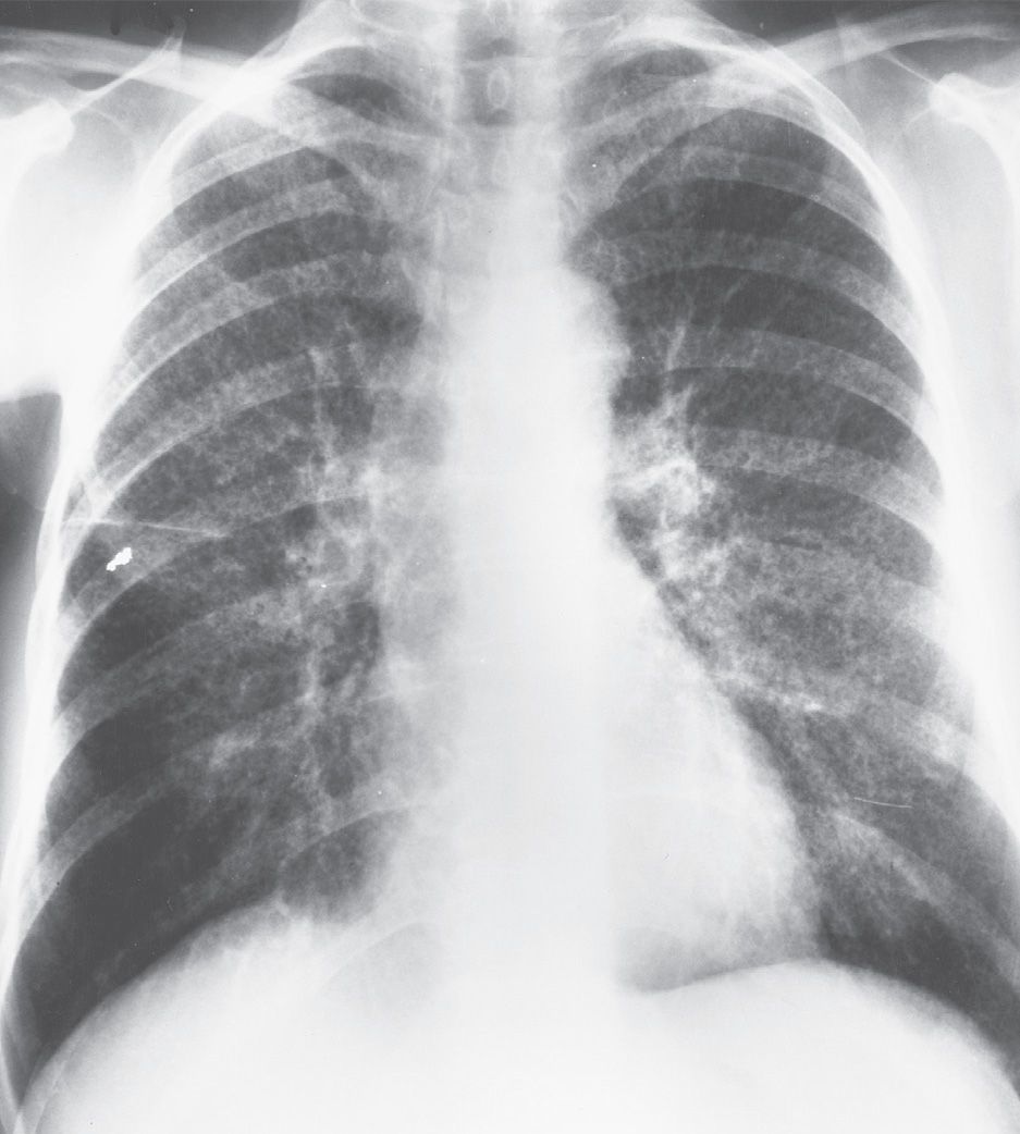 upper-lung-disease-infection-and-immunity-radiology-key