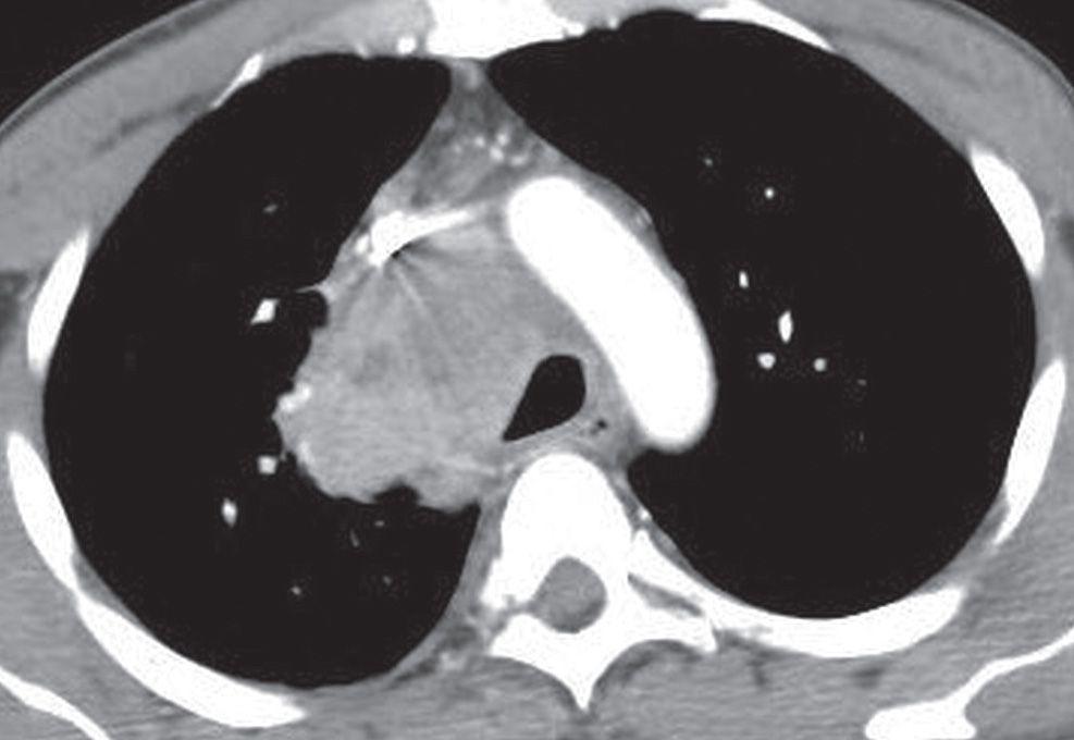 Neoplasms Of The Lung Radiology Key