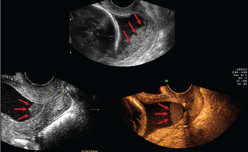 Imaging Of The Uterine Cervix | Radiology Key