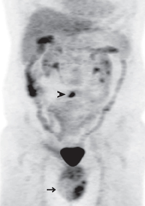 Urologic Tumors Radiology Key