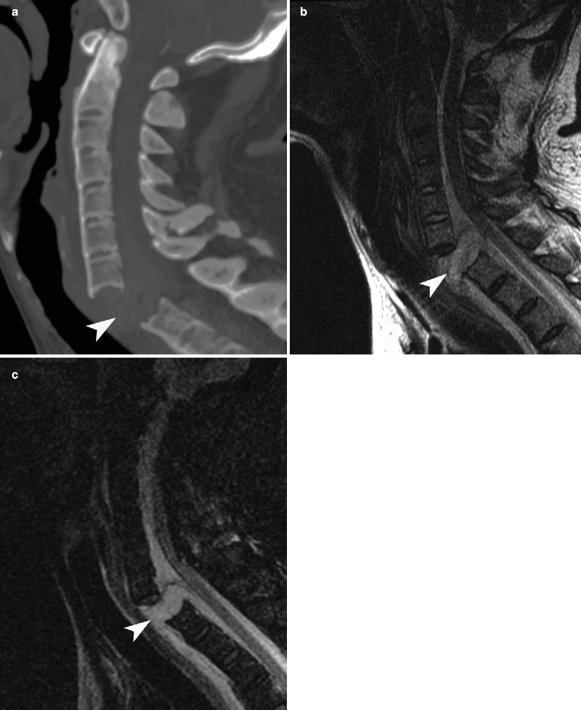 Imaging Of Spinal Trauma Radiology Key