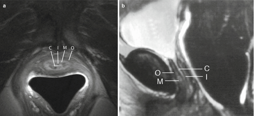Cross-Sectional Imaging of the Female Urethra | Radiology Key