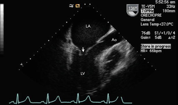 Infective Endocarditis Radiology Key