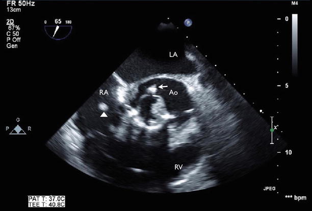 Infective Endocarditis Radiology Key