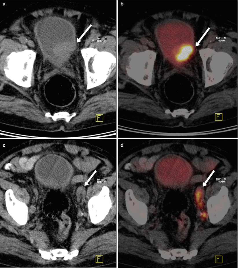 Urologic Tumors Radiology Key