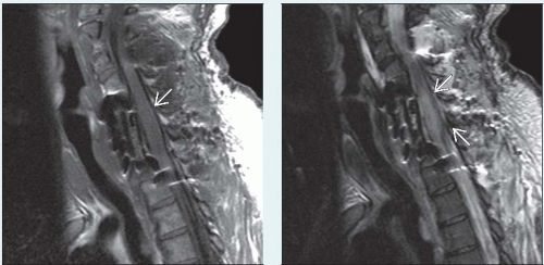 Spinal Cord Infarction Radiology Key 10800 Hot Sex Picture 5635