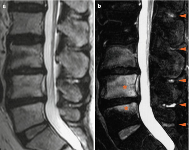 Mri In Degenerative Disease Of The Spine Radiology Key