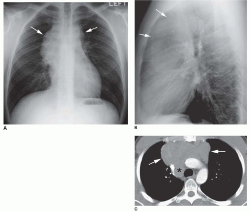 Lymphoma and Lymphoproliferative Disease | Radiology Key