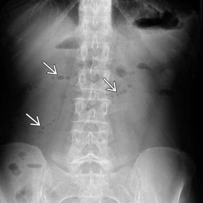 What Is A Small Bowel Series Looking For