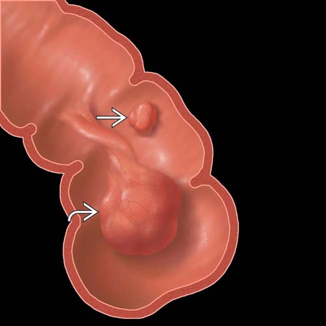 Colonic Polyps Radiology Key