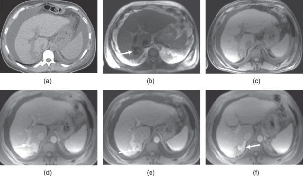 Benign Solid Liver Lesions Radiology Key