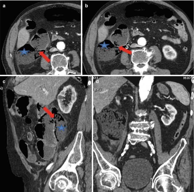 Acute Perforated Diverticulitis Spectrum Of Mdct Findings Radiology Key