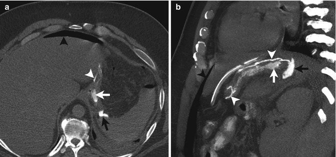 Acute Perforated Diverticulitis Spectrum Of Mdct Findings Radiology Key