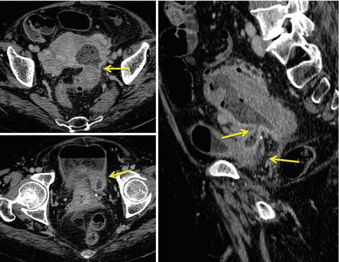 Acute Perforated Diverticulitis Spectrum Of MDCT Findings Radiology Key