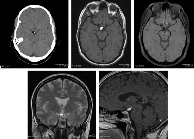 Imaging Of The Sella And Parasellar Region In The Pediatric Population