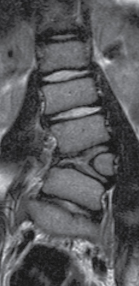 Congenital Disorders Of The Spine And Spinal Cord Radiology Key