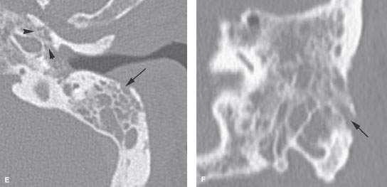 View Malignant Otitis Externa Ct Protocol PNG