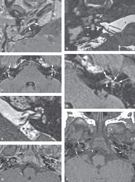 virus of labyrinthitis