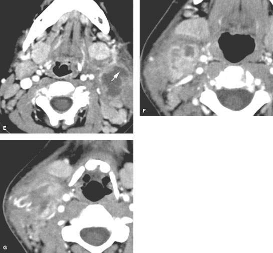 Cervical Adenopathy Reactive And Infectious Radiology Key