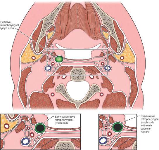 Retropharyngeal And Prevertebral Space Inflammatory Conditions