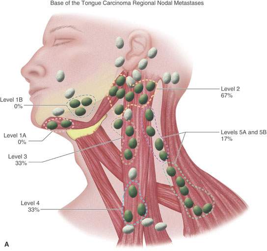 Cervical Metastatic Disease And The “unknown” Primary Radiology Key 4483