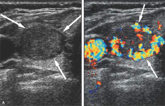 thyroid cancer ultrasound