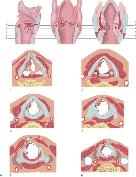 Larynx Malignant Tumors Radiology Key