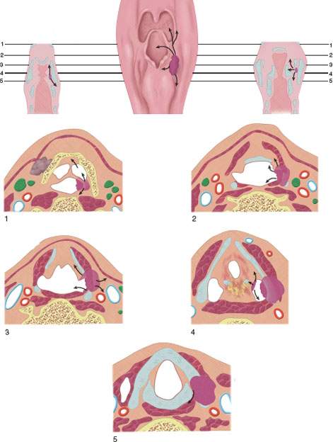 pyriform sinus cancer