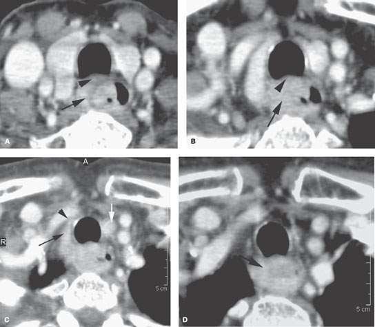 Cervical Esophagus Benign And Malignant Tumors Radiology Key