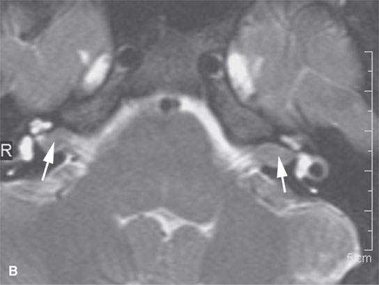 Benign And Malignant Peripheral Nerve Sheath Tumors Radiology Key 