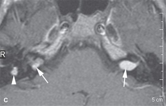 Benign And Malignant Peripheral Nerve Sheath Tumors Radiology Key 