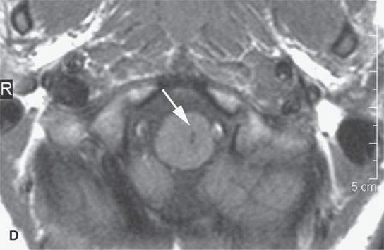 Benign And Malignant Peripheral Nerve Sheath Tumors Radiology Key 