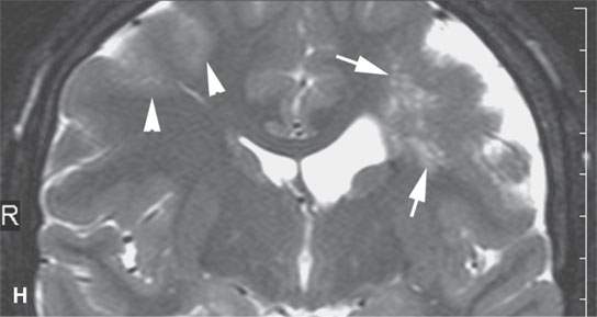 Benign And Malignant Peripheral Nerve Sheath Tumors Radiology Key 