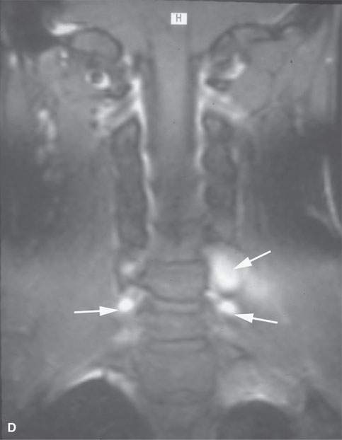 Benign And Malignant Peripheral Nerve Sheath Tumors Radiology Key 