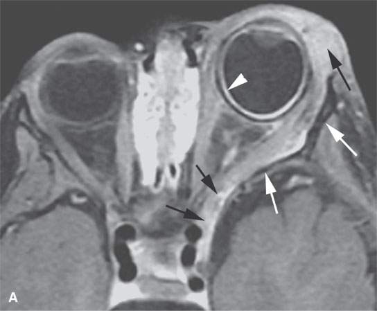 Benign And Malignant Peripheral Nerve Sheath Tumors Radiology Key 4675