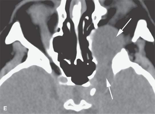 Benign And Malignant Peripheral Nerve Sheath Tumors Radiology Key 