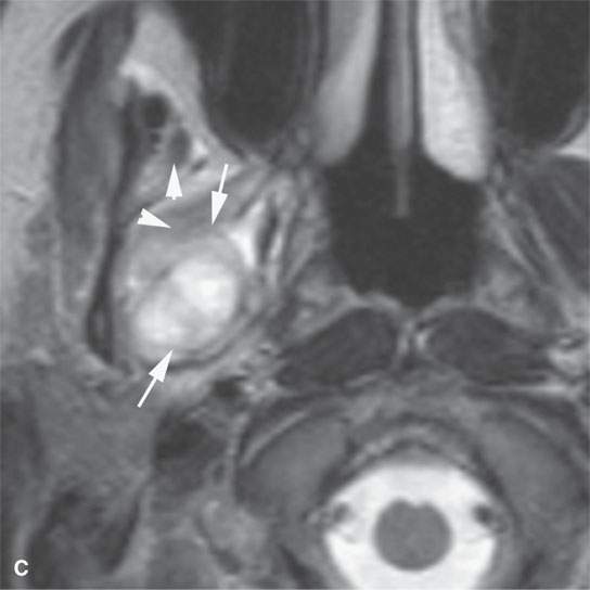 Benign And Malignant Mesenchymal Tumors Muscle And Other Cell Line