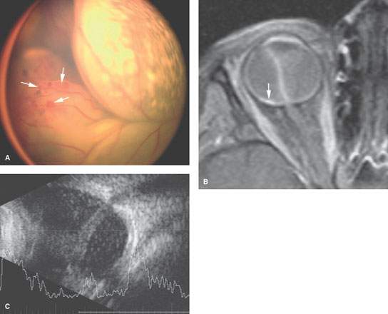 Eye Retinal Choroidal and Hyaloid Detachments Radiology Key