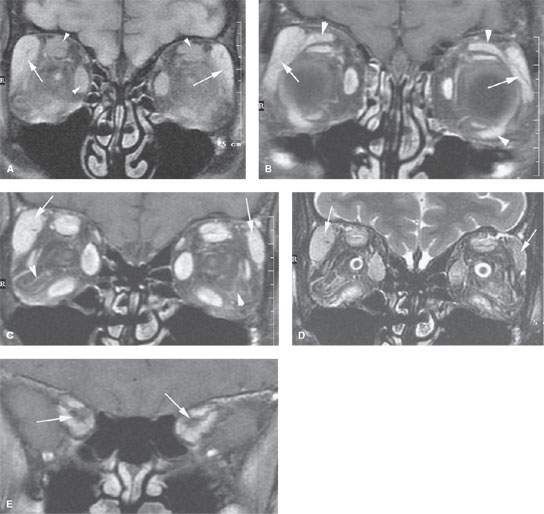 Graves Dysthyroid Ophthalmopathy Orbitopathy Radiology Key 