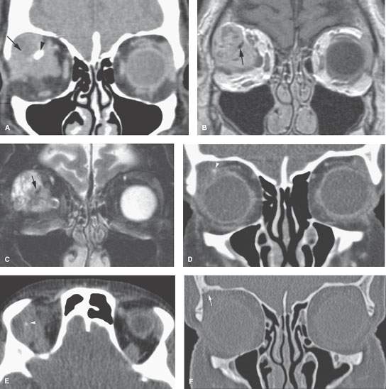 Adenoid Cystic Carcinoma Lacrimal Gland 