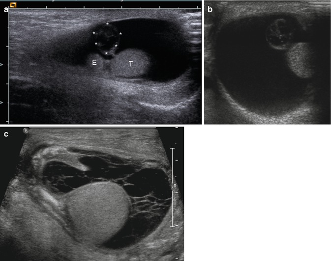 Doppler Sonography Of The Scrotum Radiology Key 7119