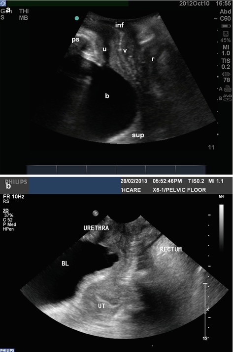 Medical Illustration Showing Difference Normal Uterus Prolapsed